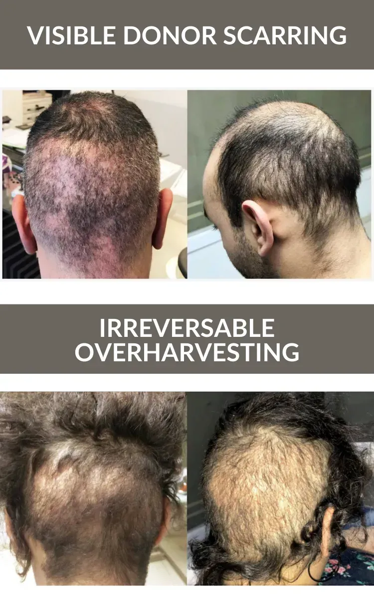 A collage of photos of a man 's and woman 's hair before and after donor scarring.