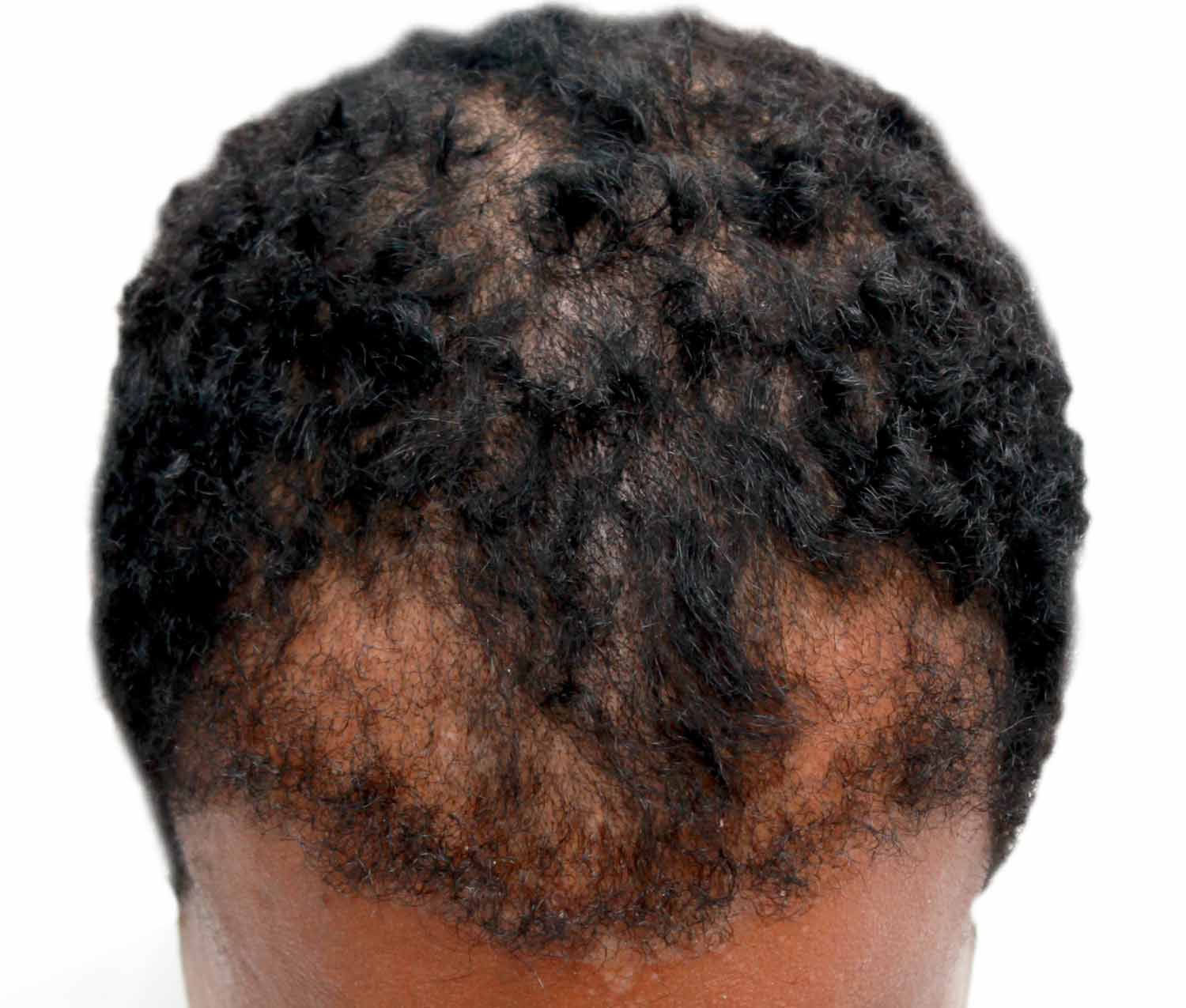 Before hair restoration | Real patient, results may vary per individual