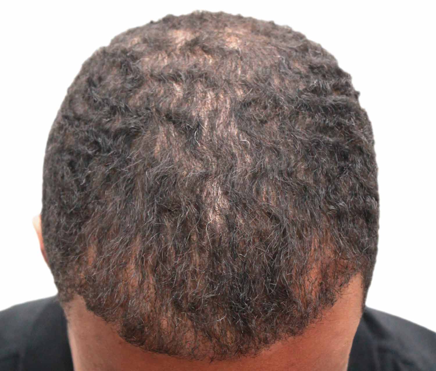 After hair restoration | Real patient, results may vary per individual