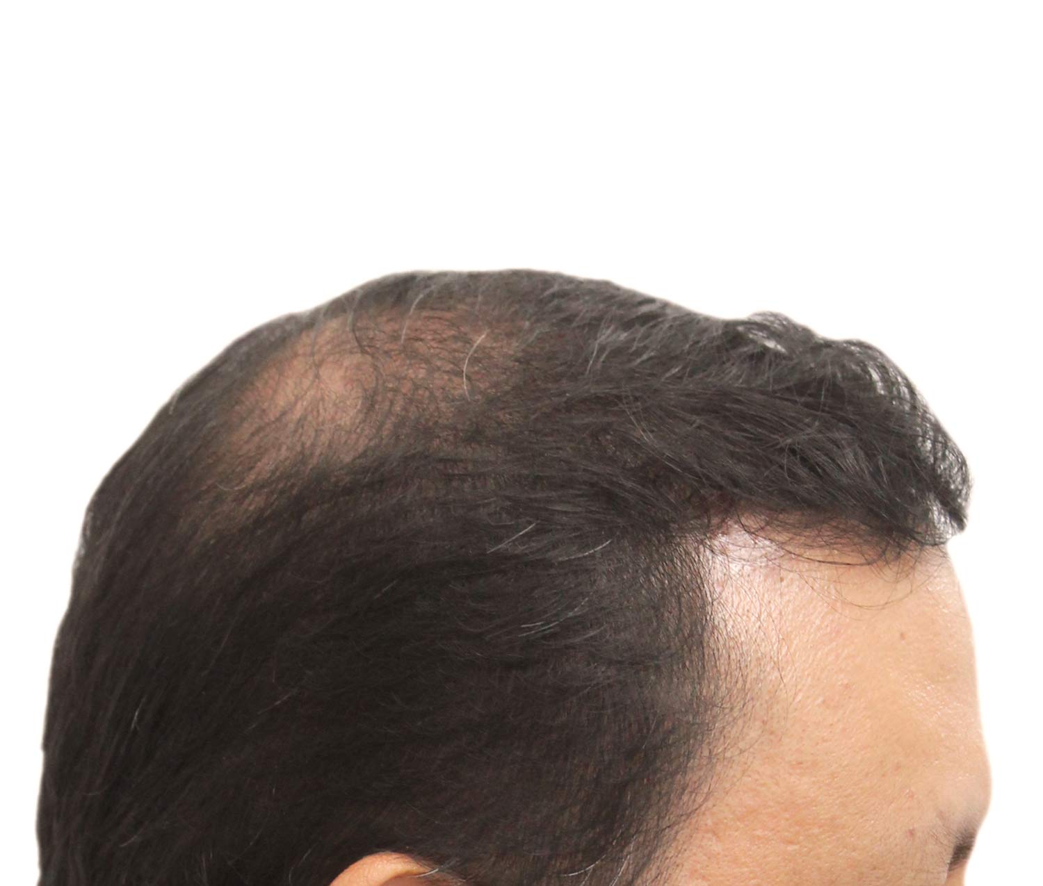 Before hair restoration | Real patient, results may vary per individual