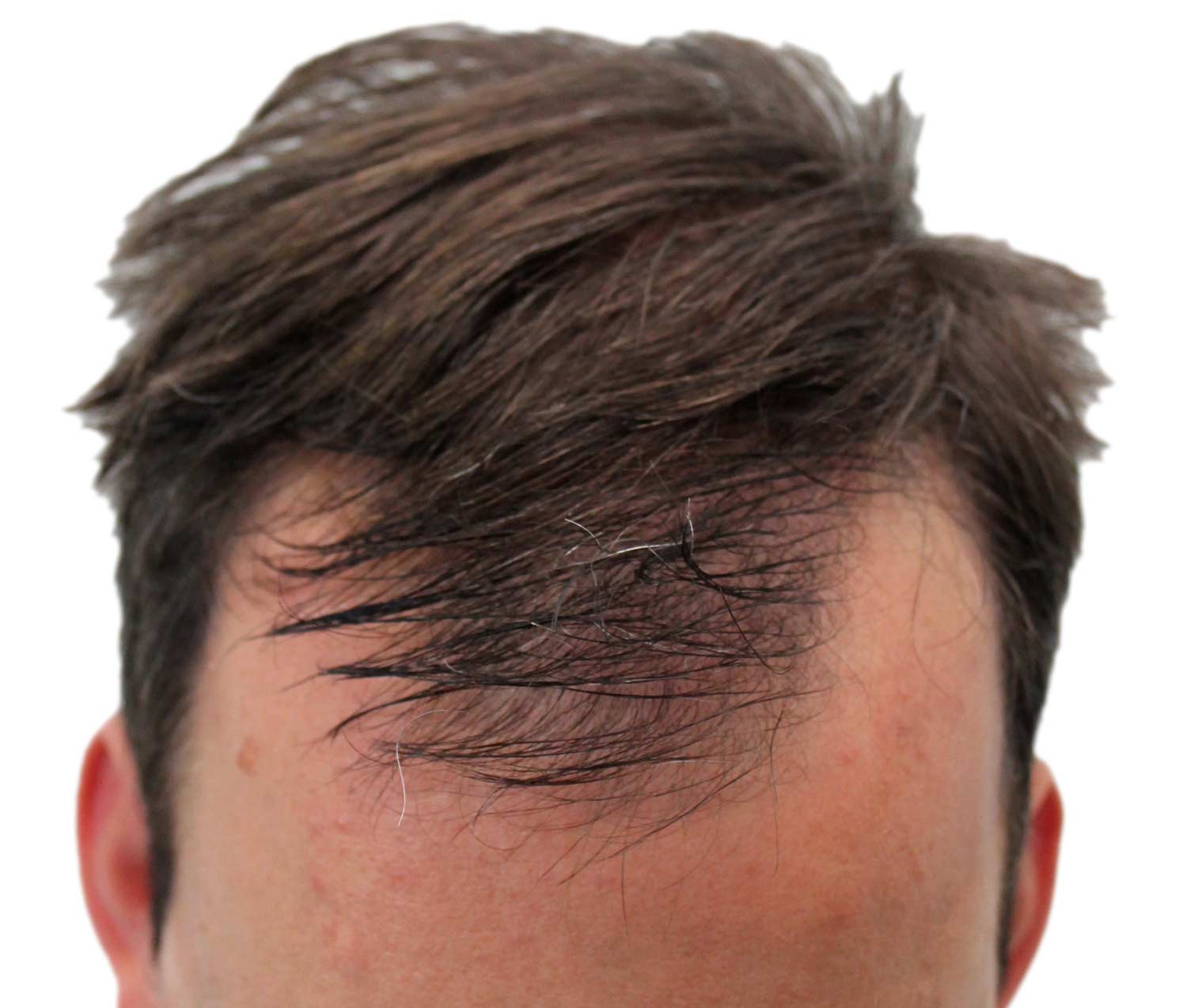 Before hair restoration | Real patient, results may vary per individual