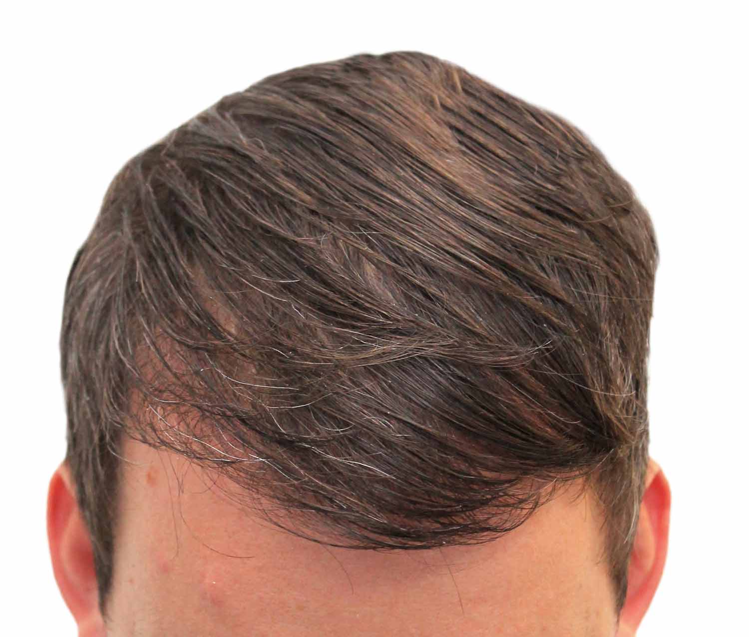 After hair restoration | Real patient, results may vary per individual