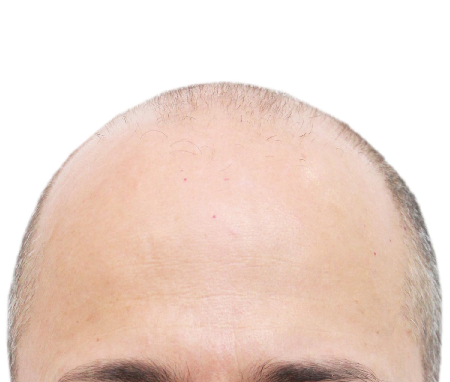Before Hair Restoration