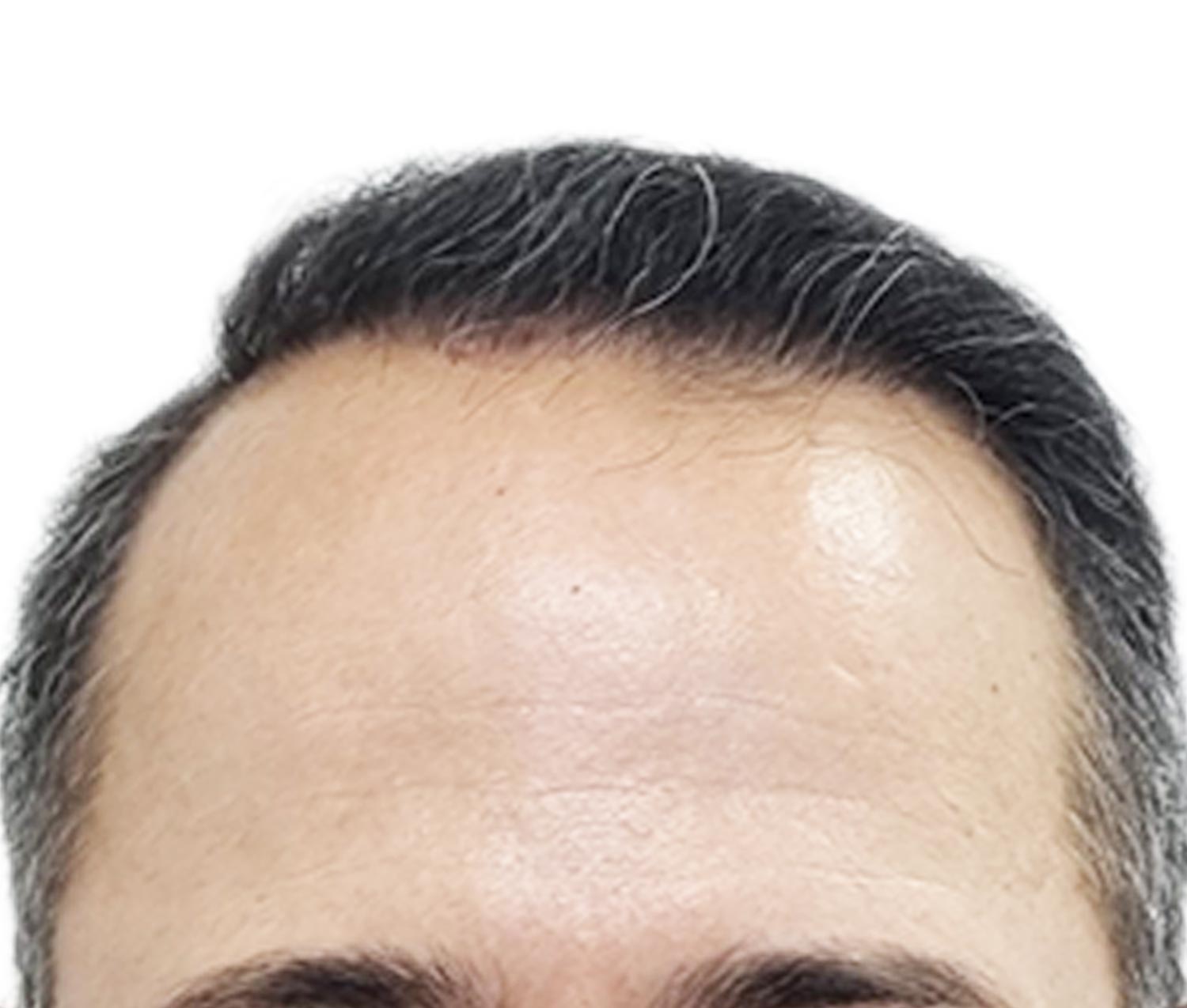 Before Hair Restoration
