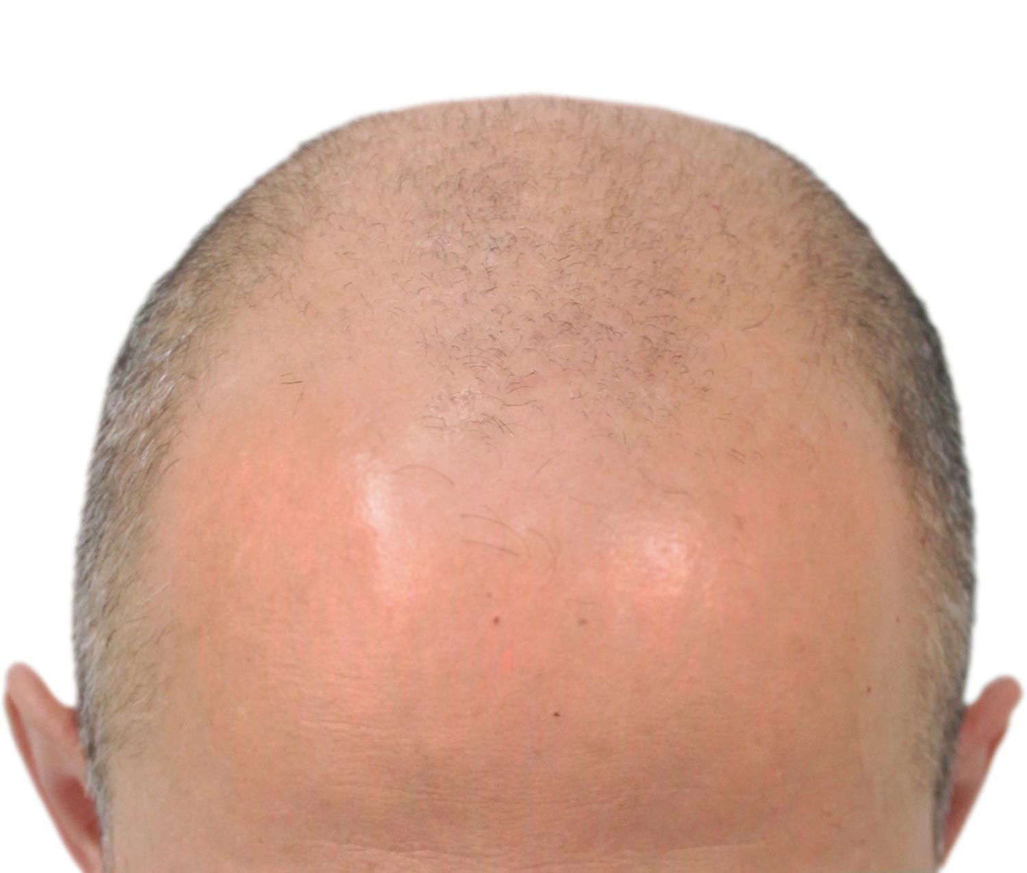 before hair restoration