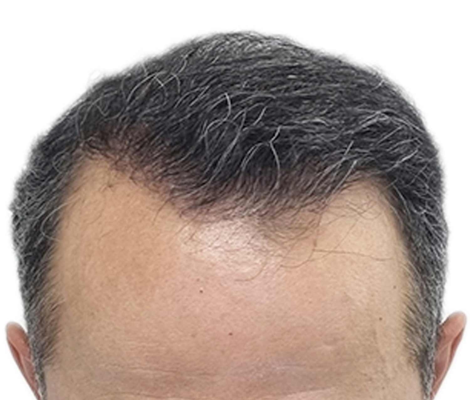 after hair restoration