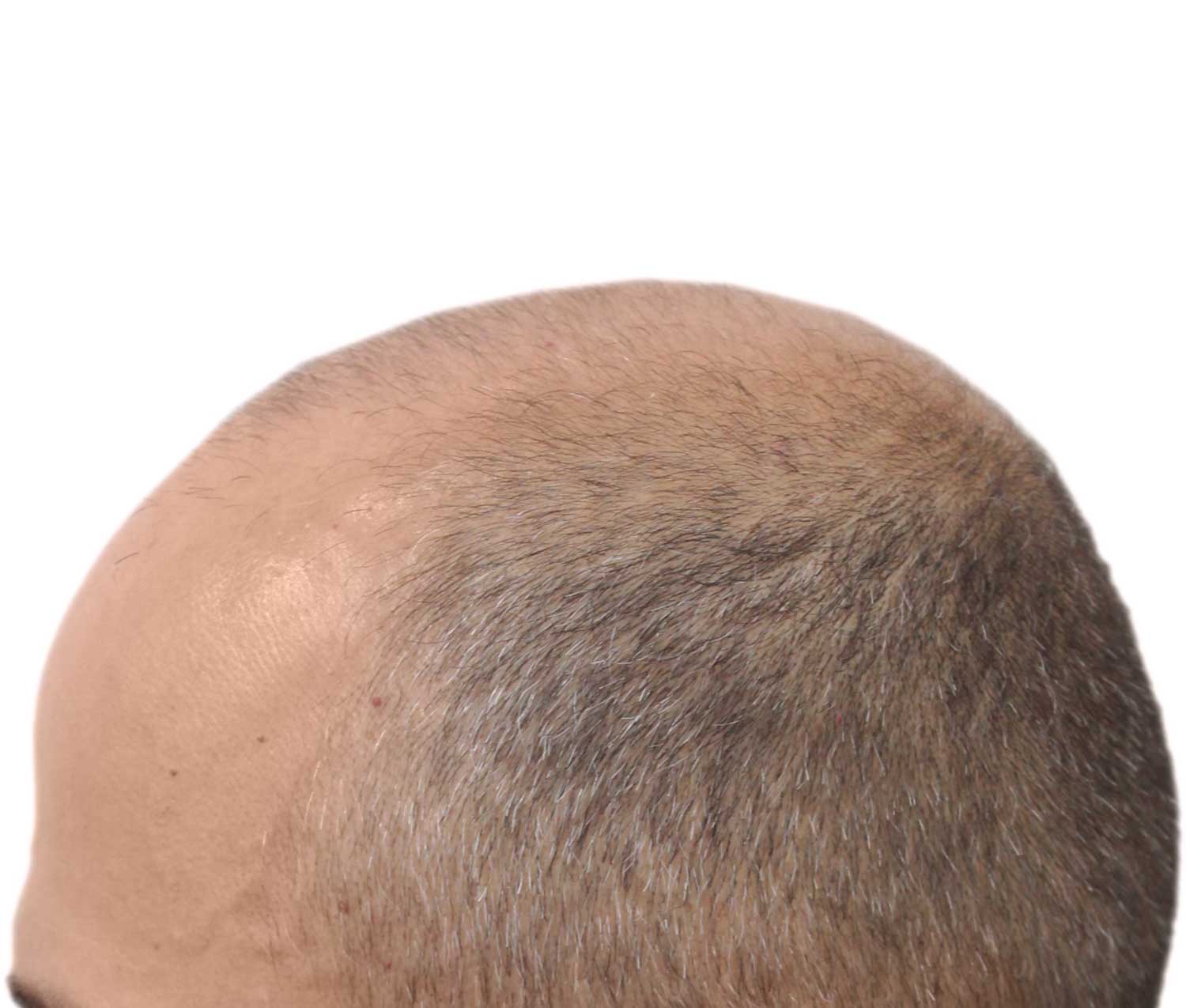 a close up of a man 's bald head on a white background .