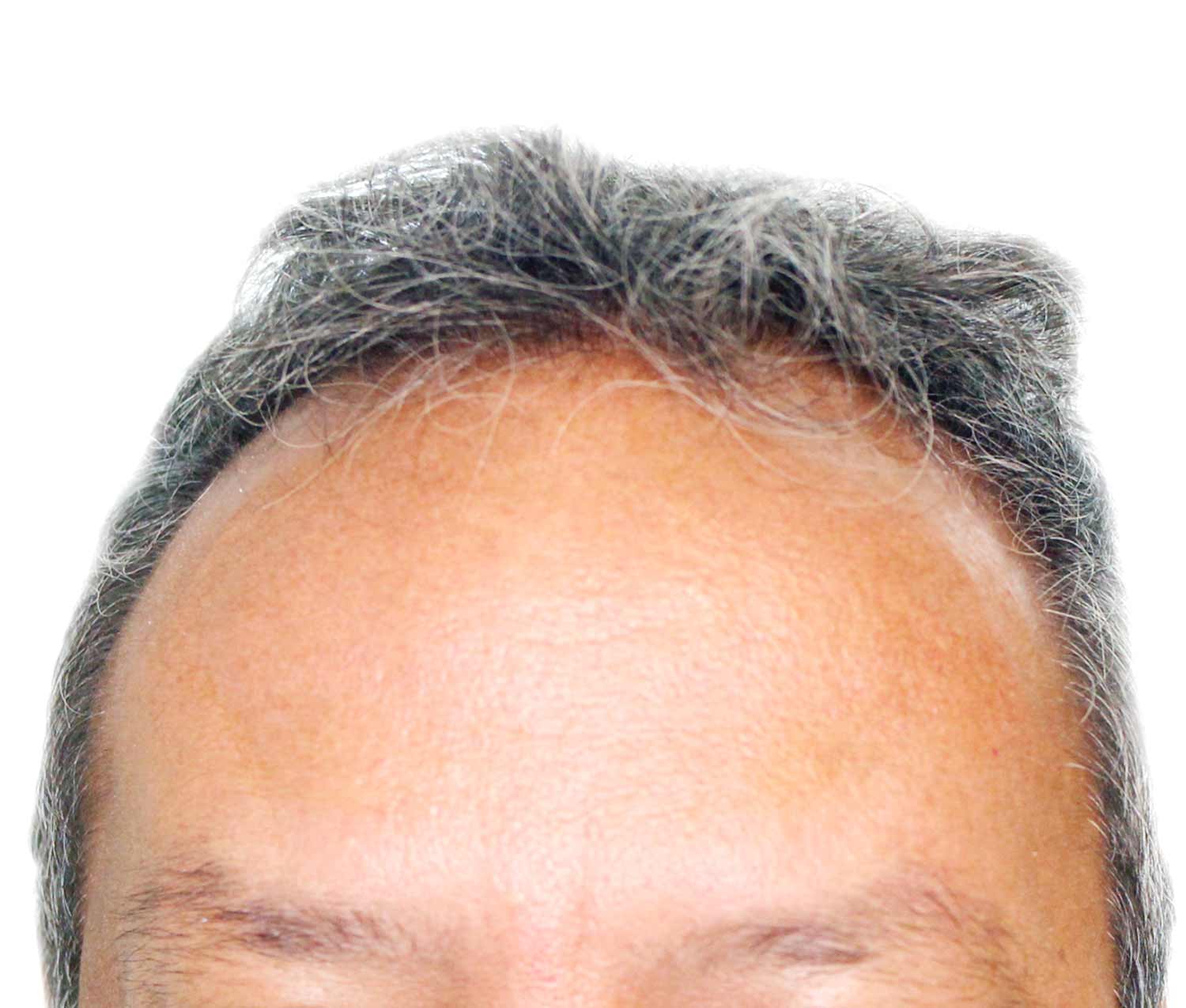 Before Hair Restoration
