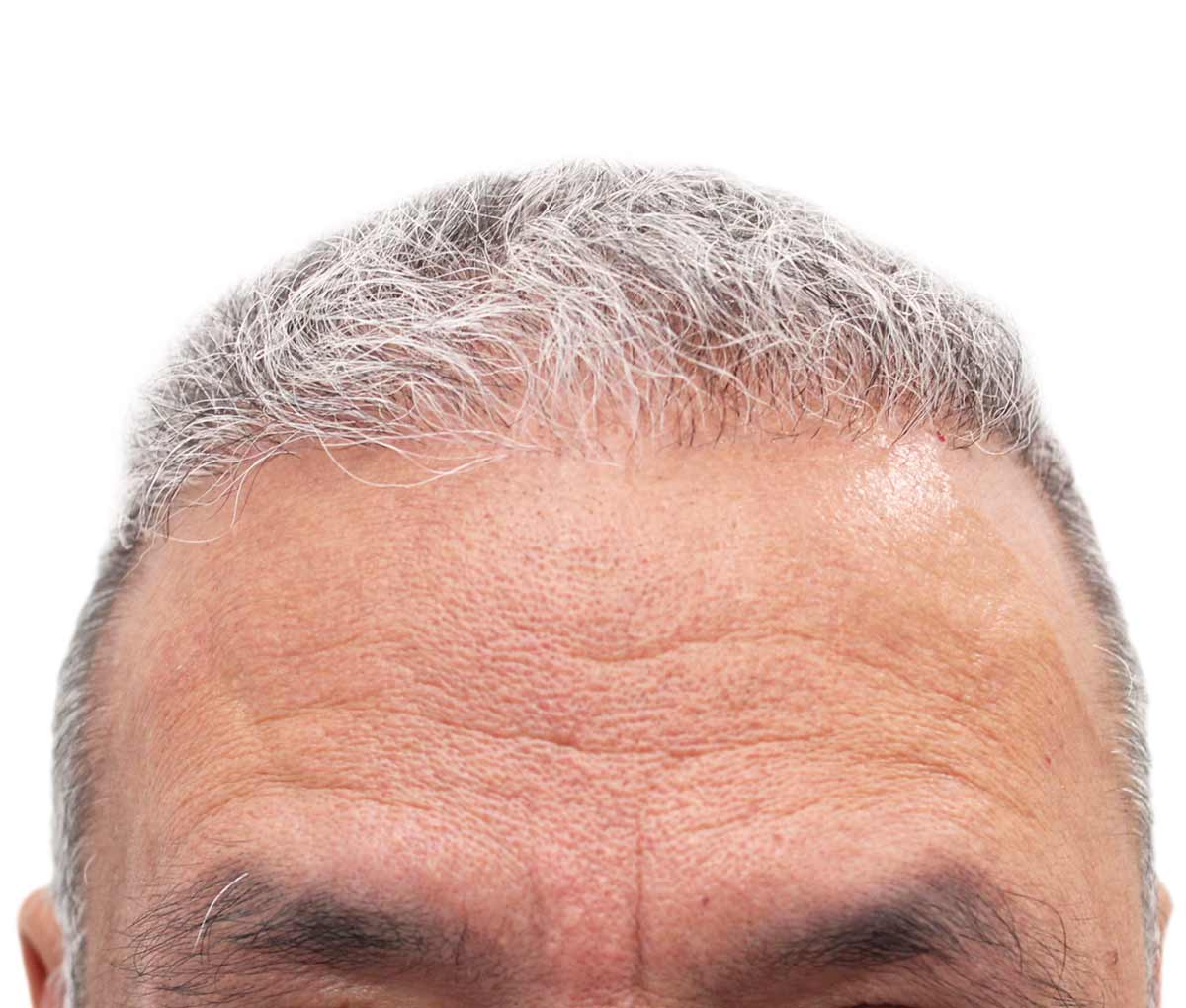 Before Hair Restoration