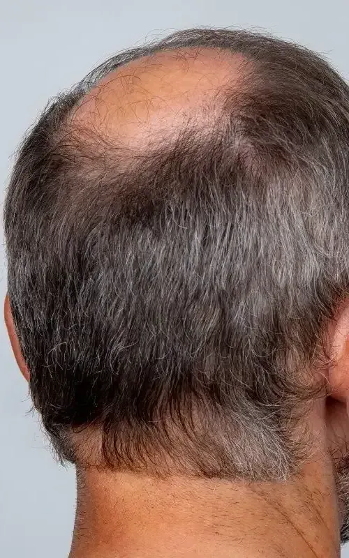the back of a man 's head with a bald spot and a beard .