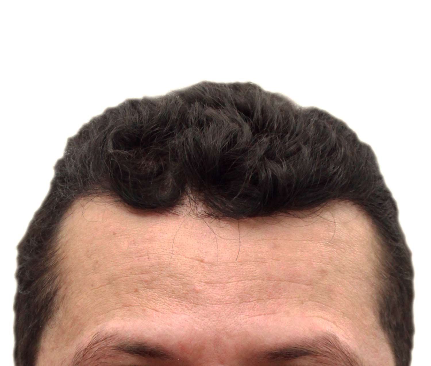 After hair restoration | Real patient, results may vary per individual