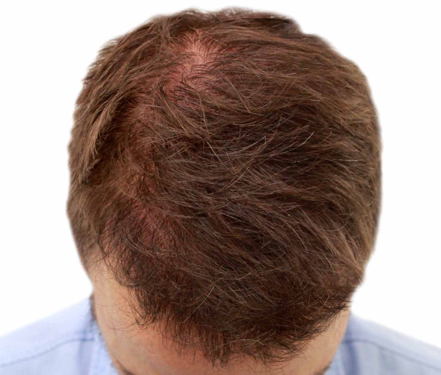 After hair restoration | Real patient, results may vary per individual