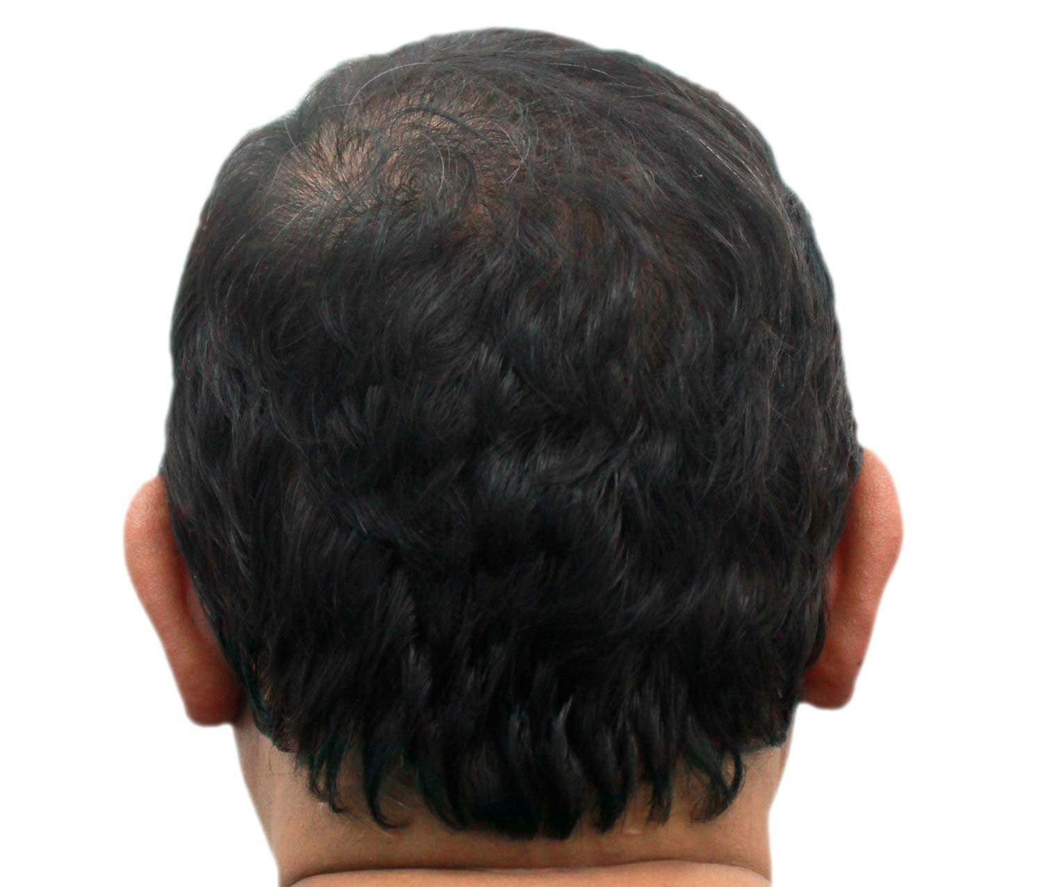 After hair restoration | Real patient, results may vary per individual