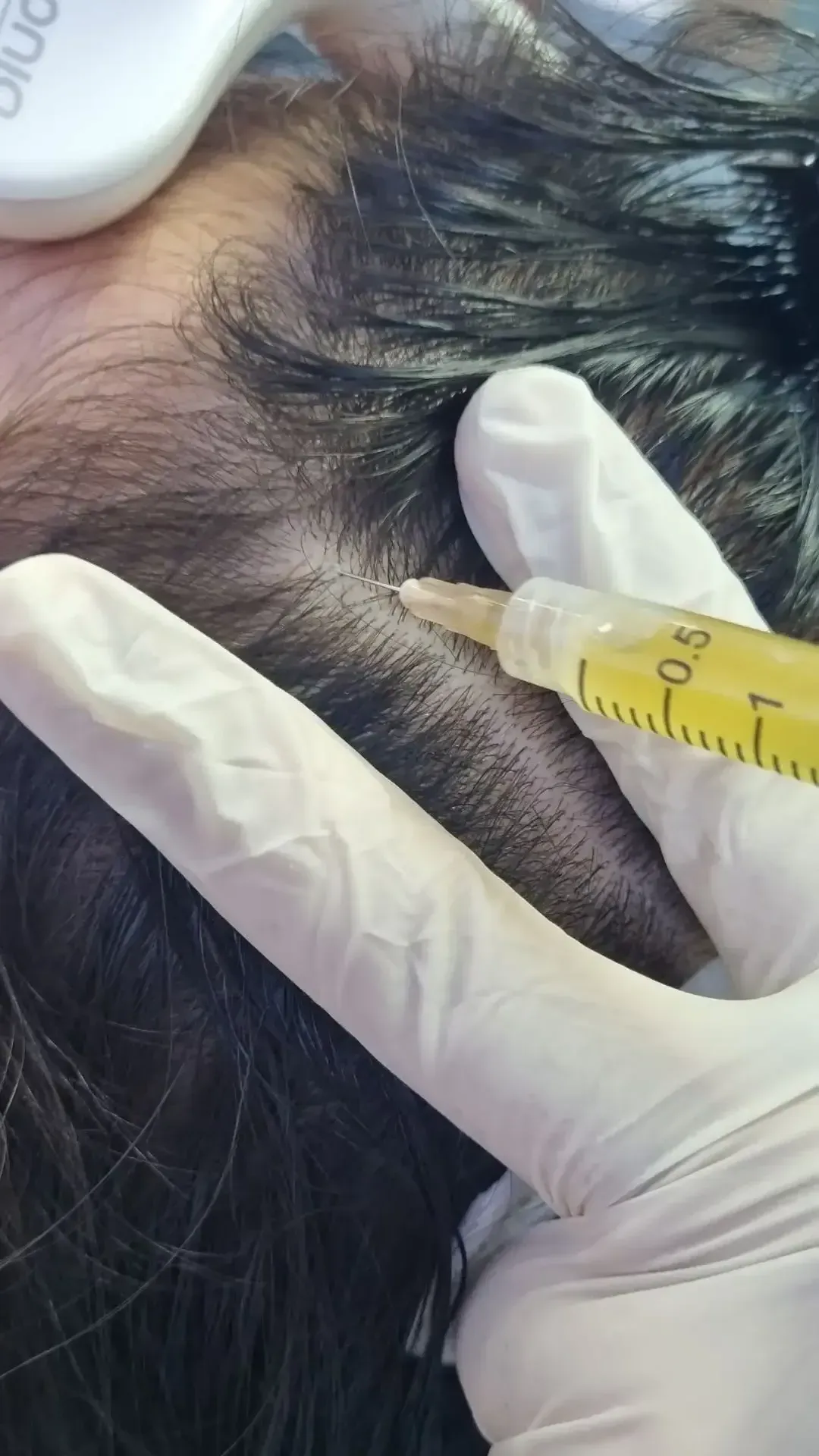 A man with a bald spot on his head.