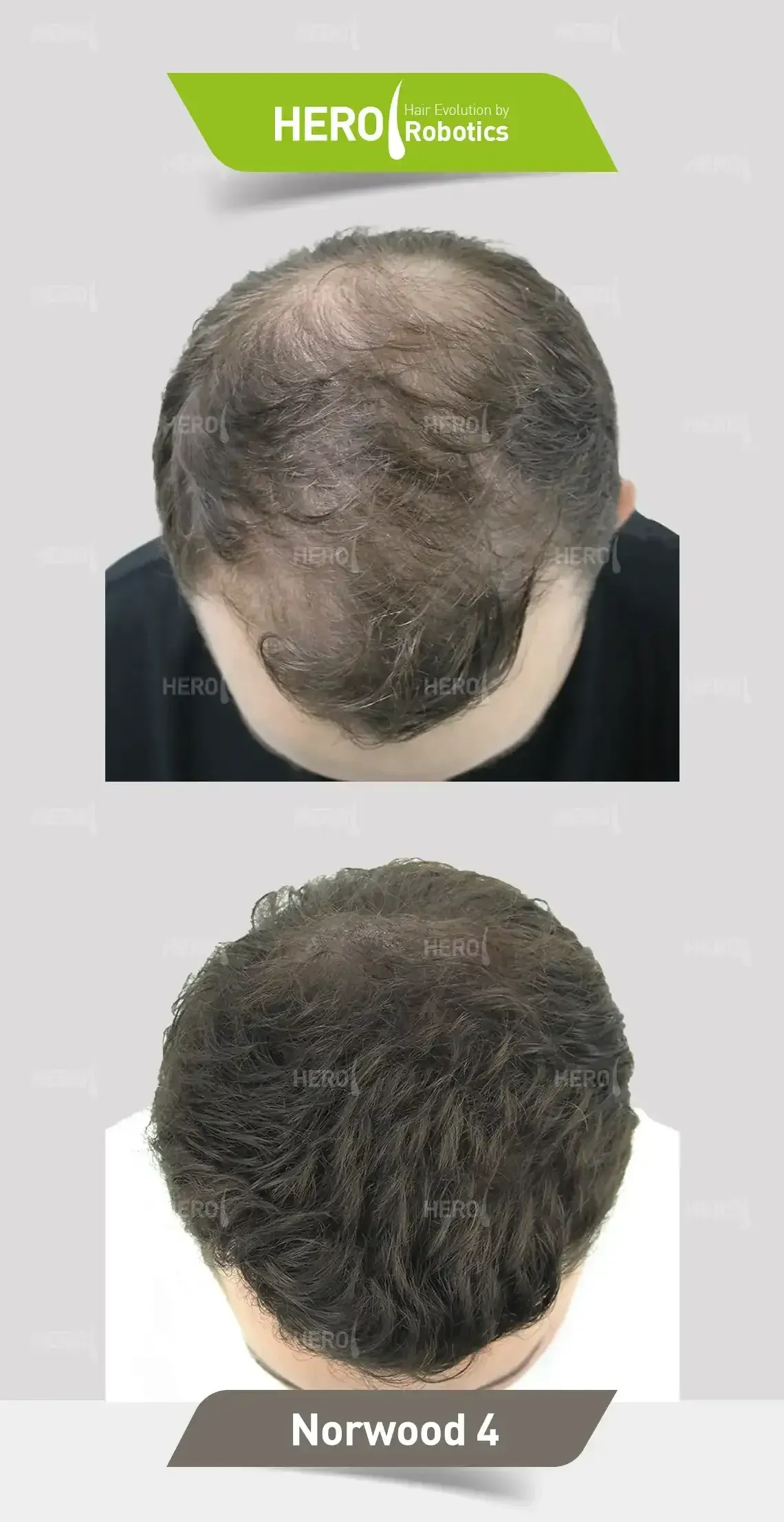 A before and after picture of a man 's hair