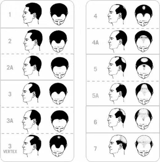 Norwood-hair-loss-scale-how-many-hair-transplants-do-I-need