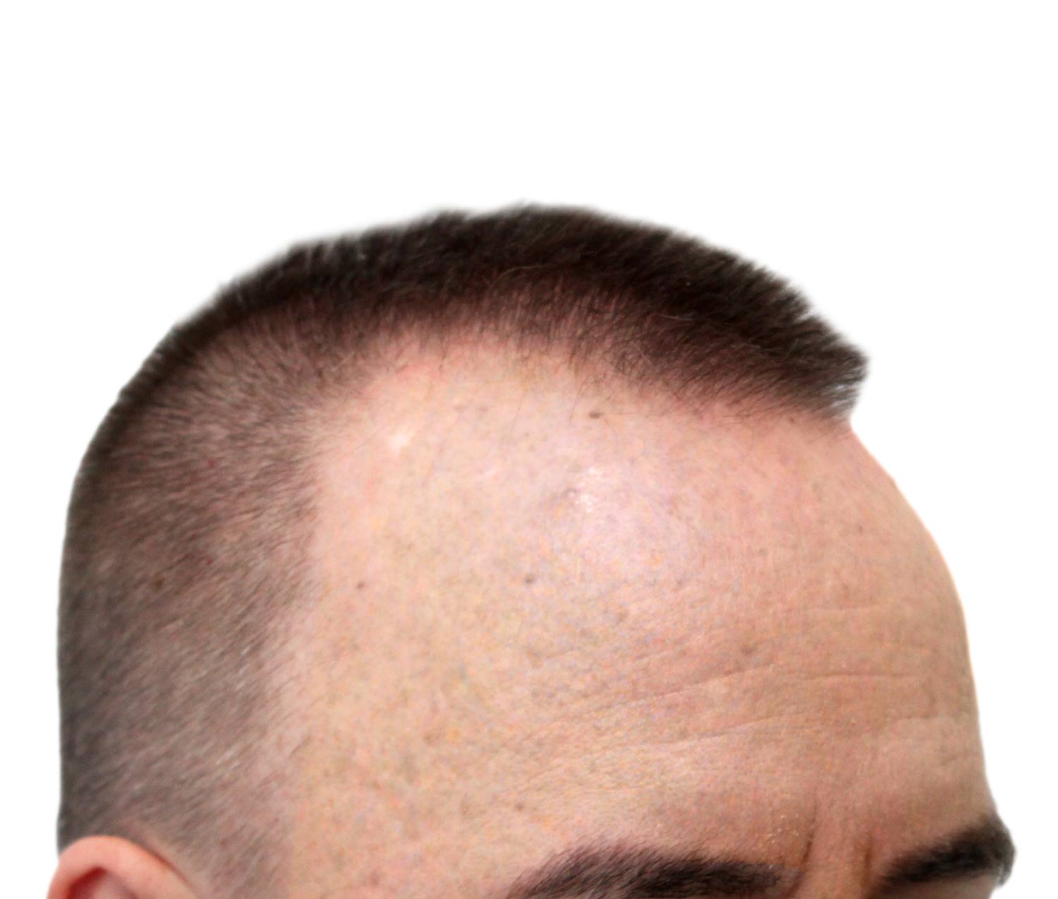 Before hair restoration | Real patient, results may vary per individual