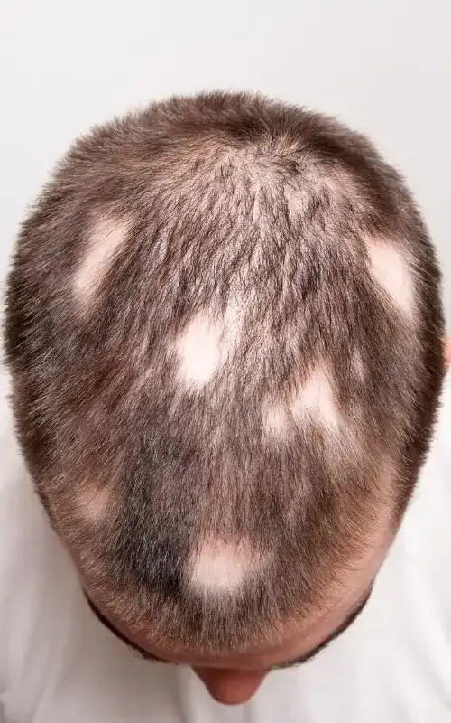 A man with a bald spot on his head.