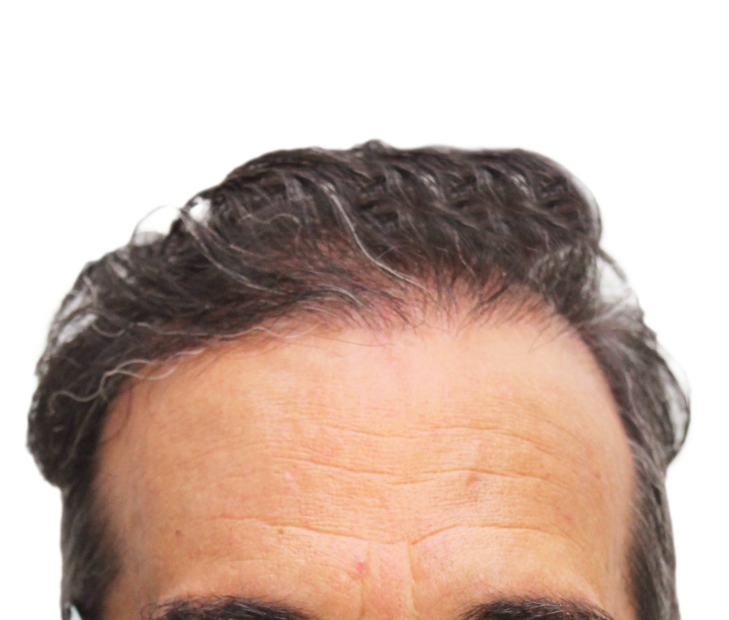 After hair restoration | Real patient, results may vary per individual