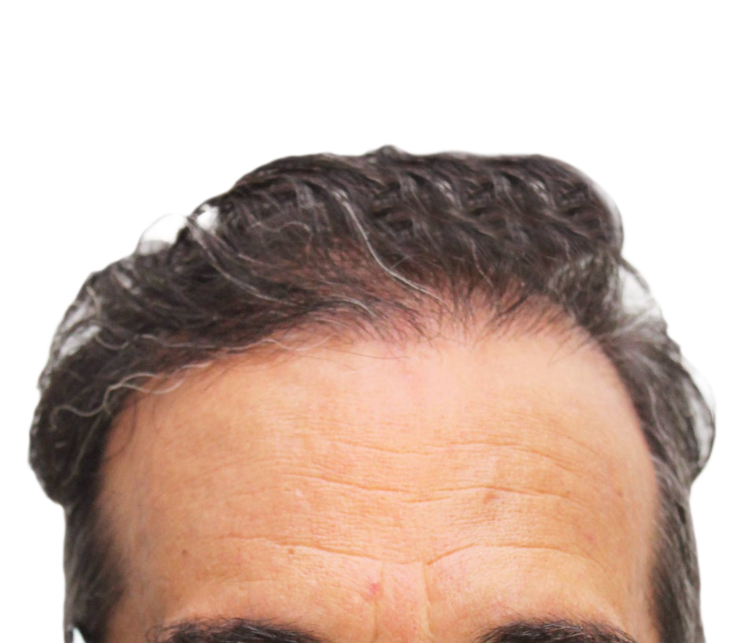 After hair restoration | Real patient, results may vary per individual