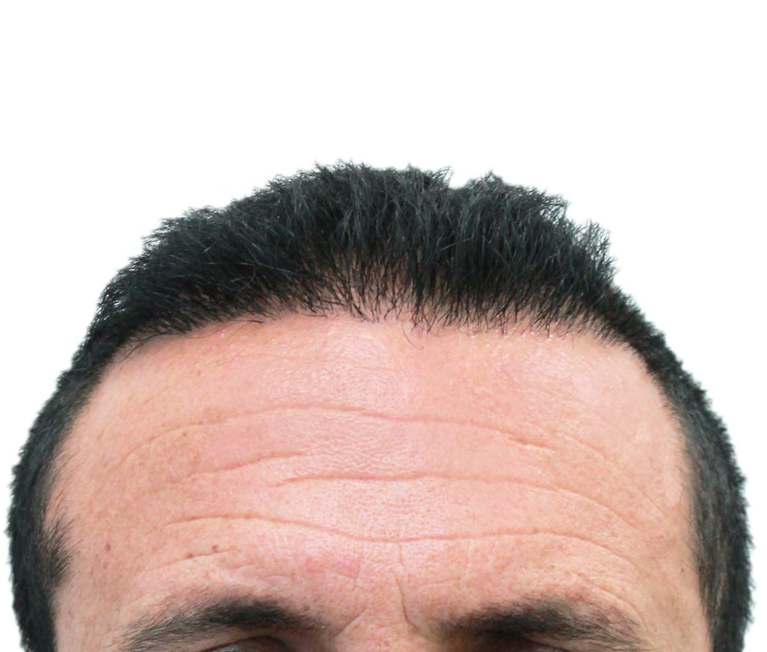 After hair restoration | Real patient, results may vary per individual