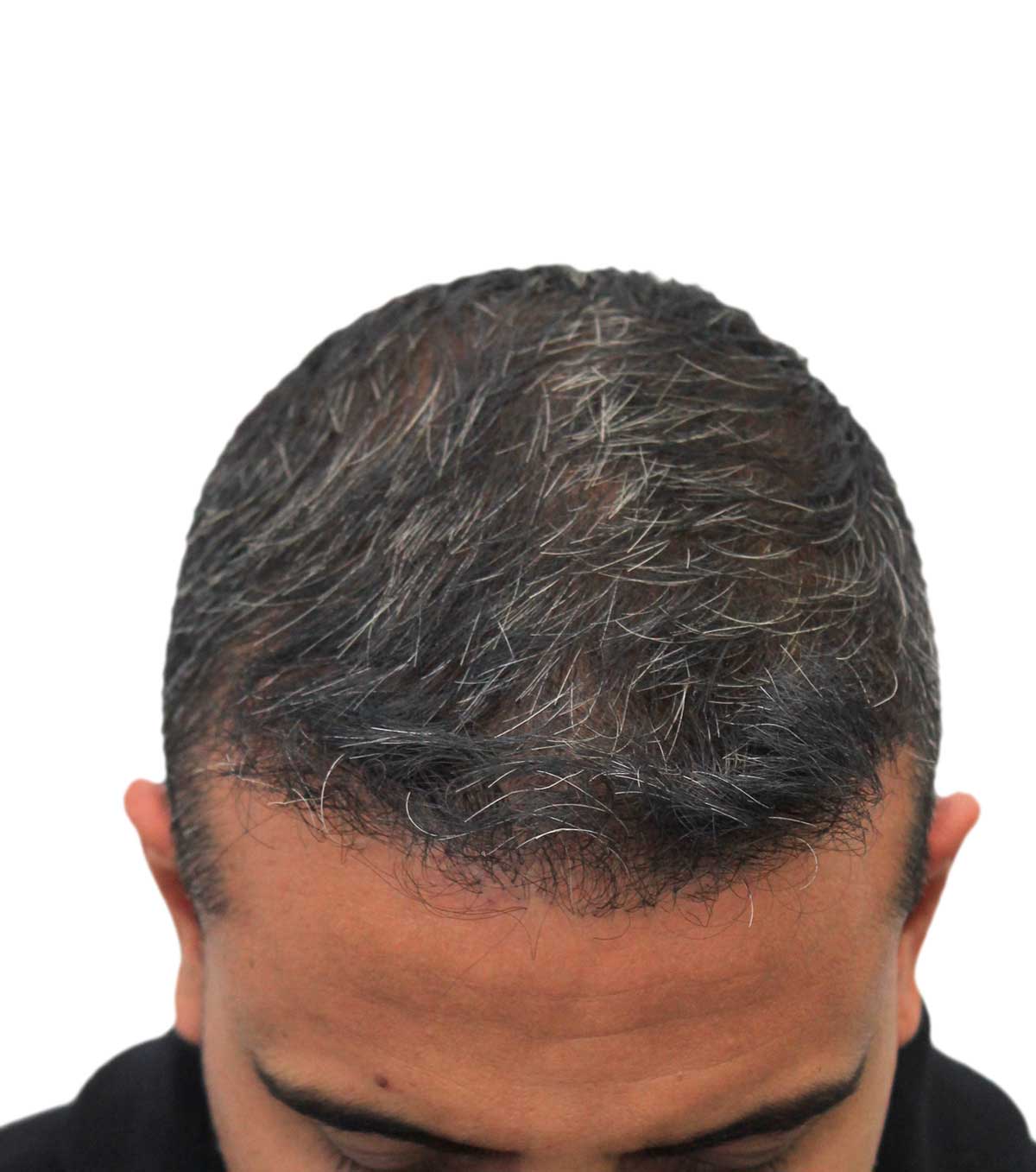 Man's head with thinning gray hair, viewed from above, against a white background.