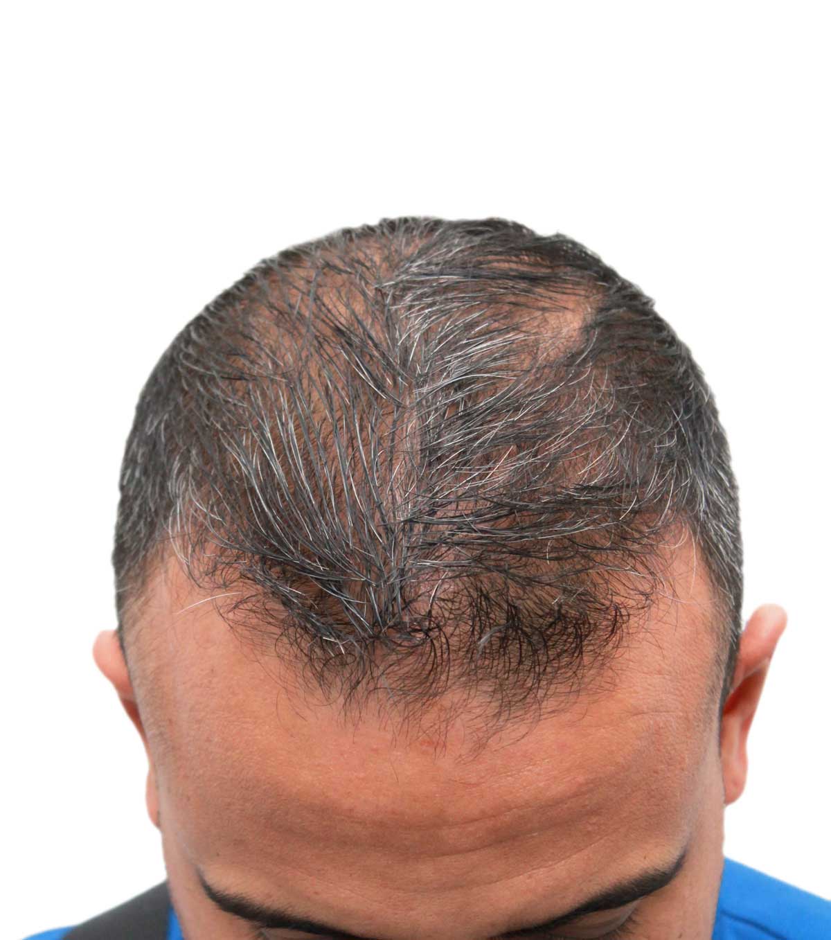 Before hair restoration | Real patient, results may vary per individual