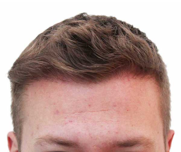 After hair transplant