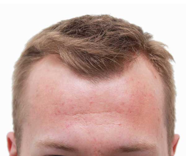 before hair transplant