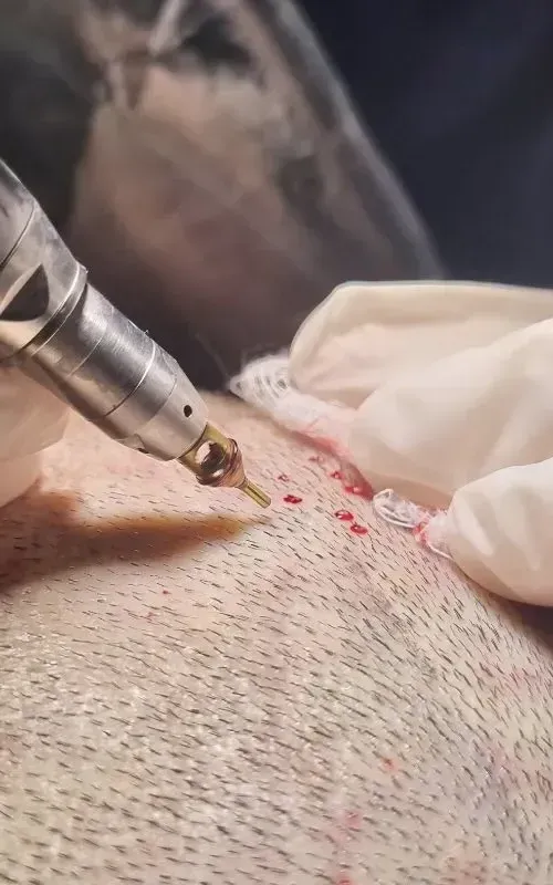 Mujer que recupero el cabello despues de trasplante