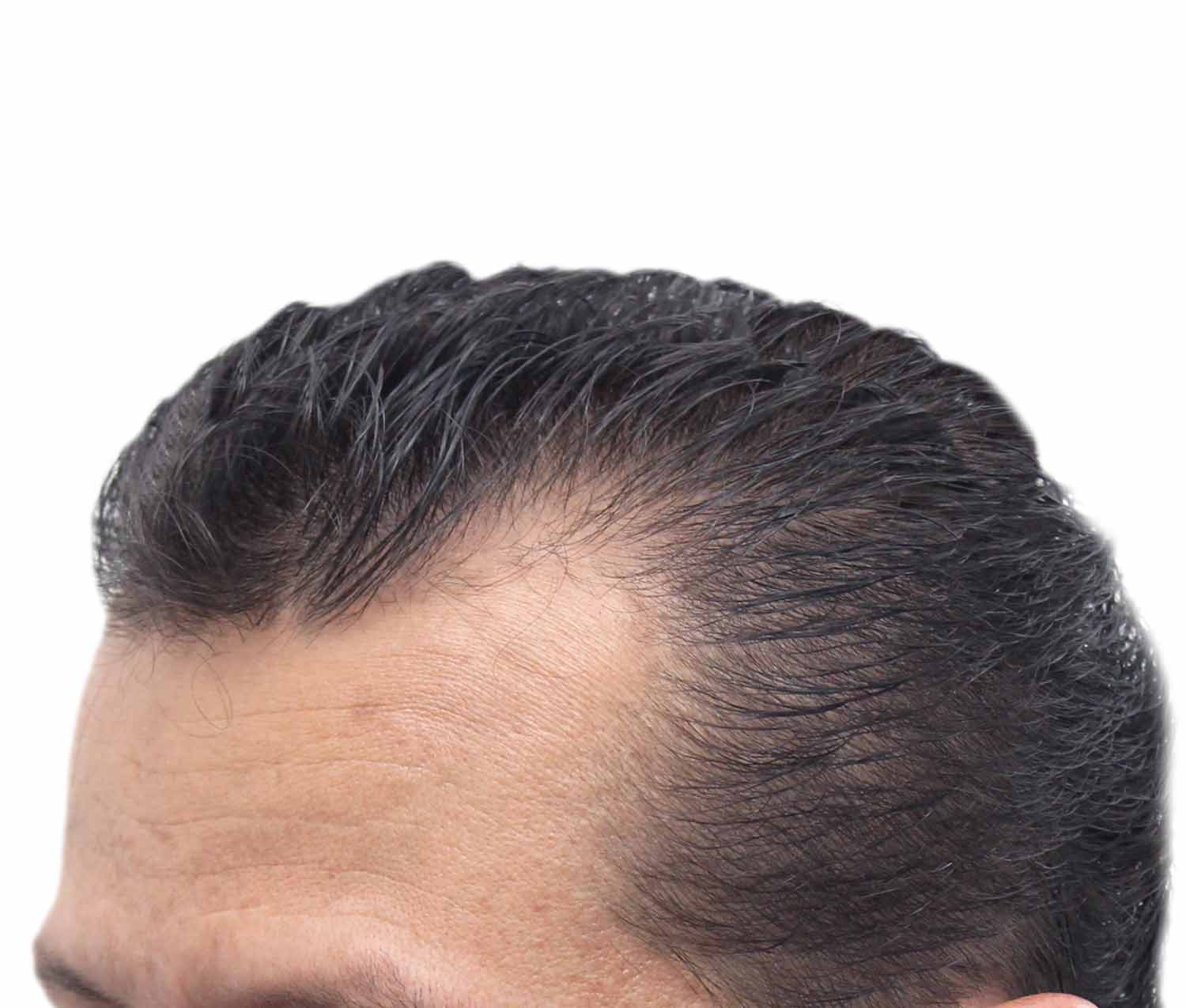 Before hair restoration | Real patient, results may vary per individual
