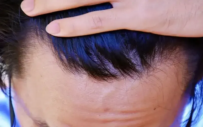 men's hairline receding