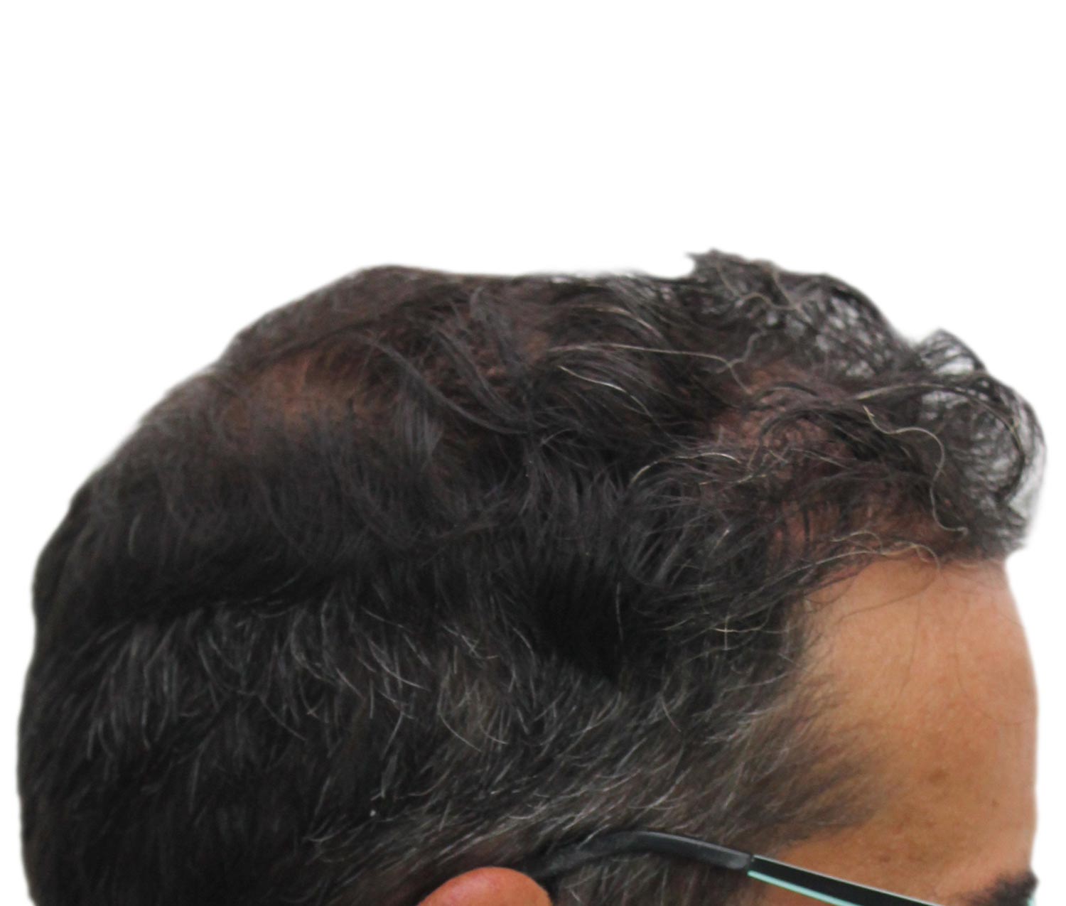 After hair restoration | Real patient, results may vary per individual