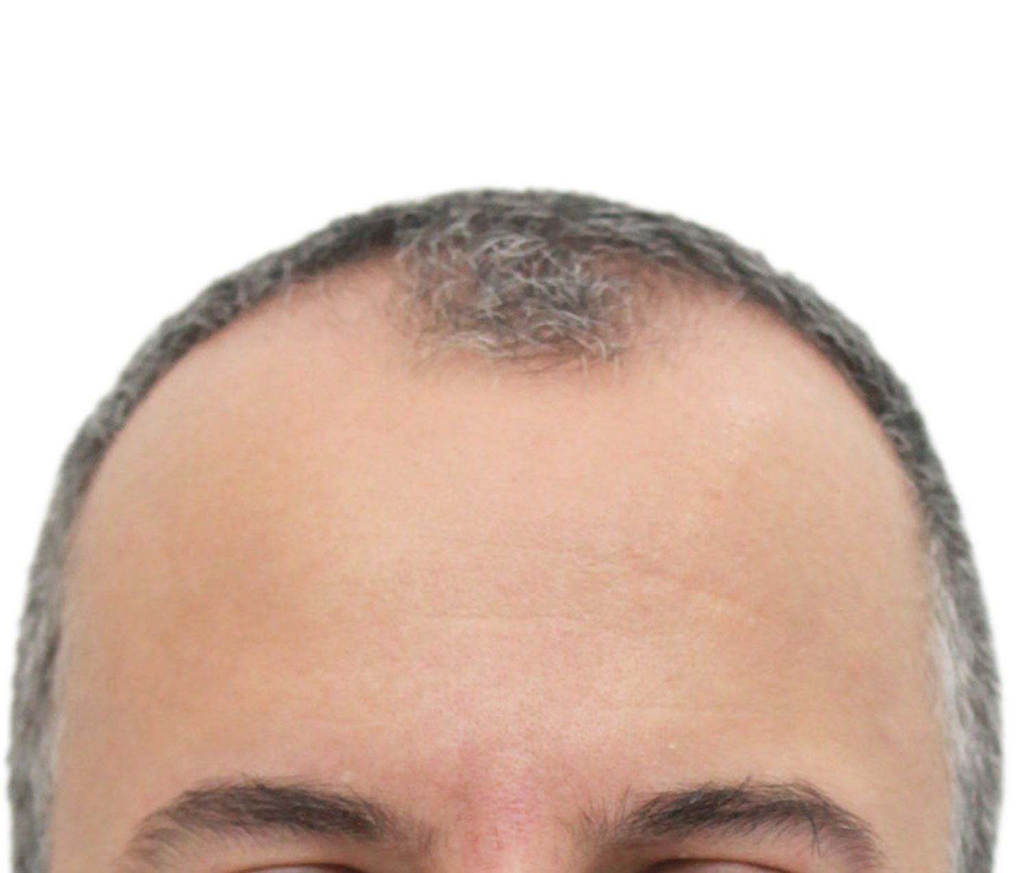 Before hair restoration | Real patient, results may vary per individual