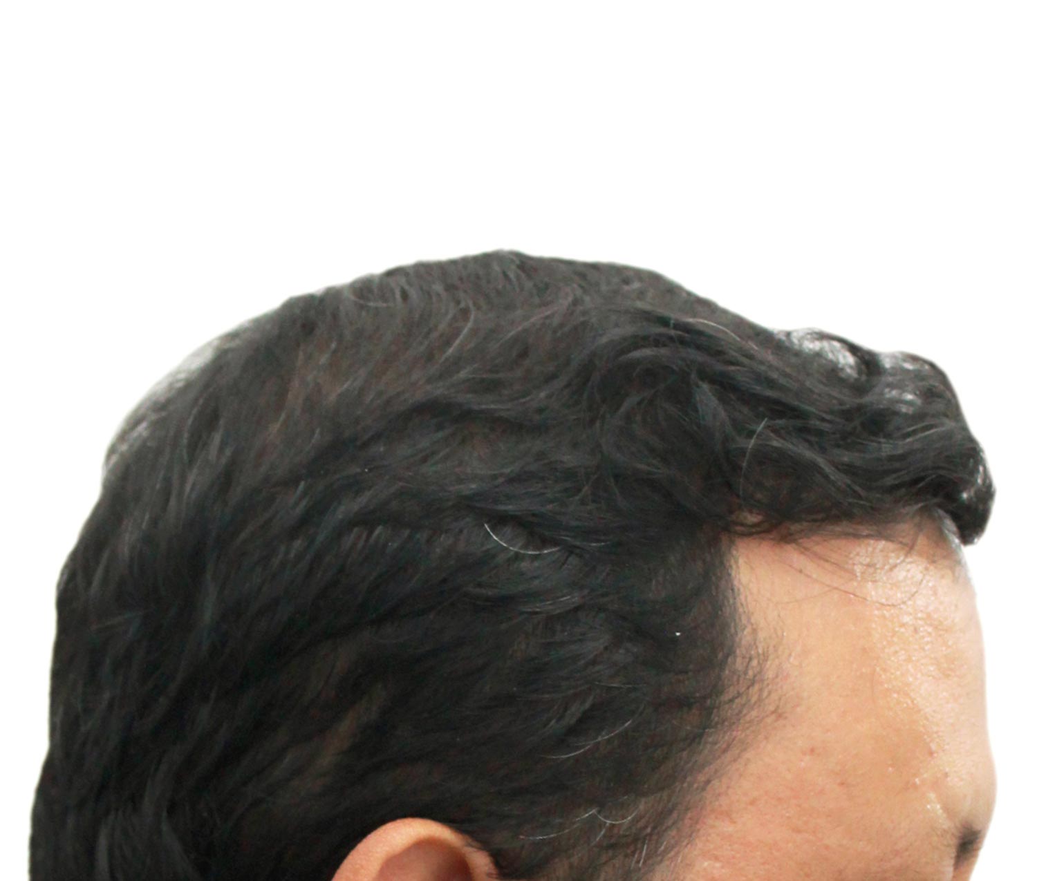 After hair restoration | Real patient, results may vary per individual