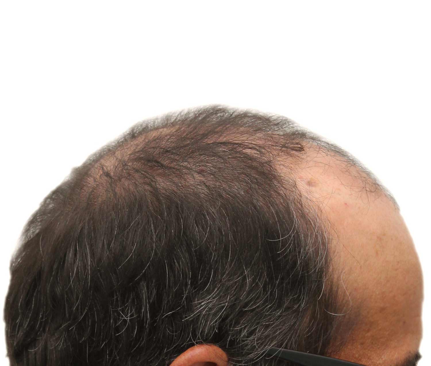 Before hair restoration | Real patient, results may vary per individual