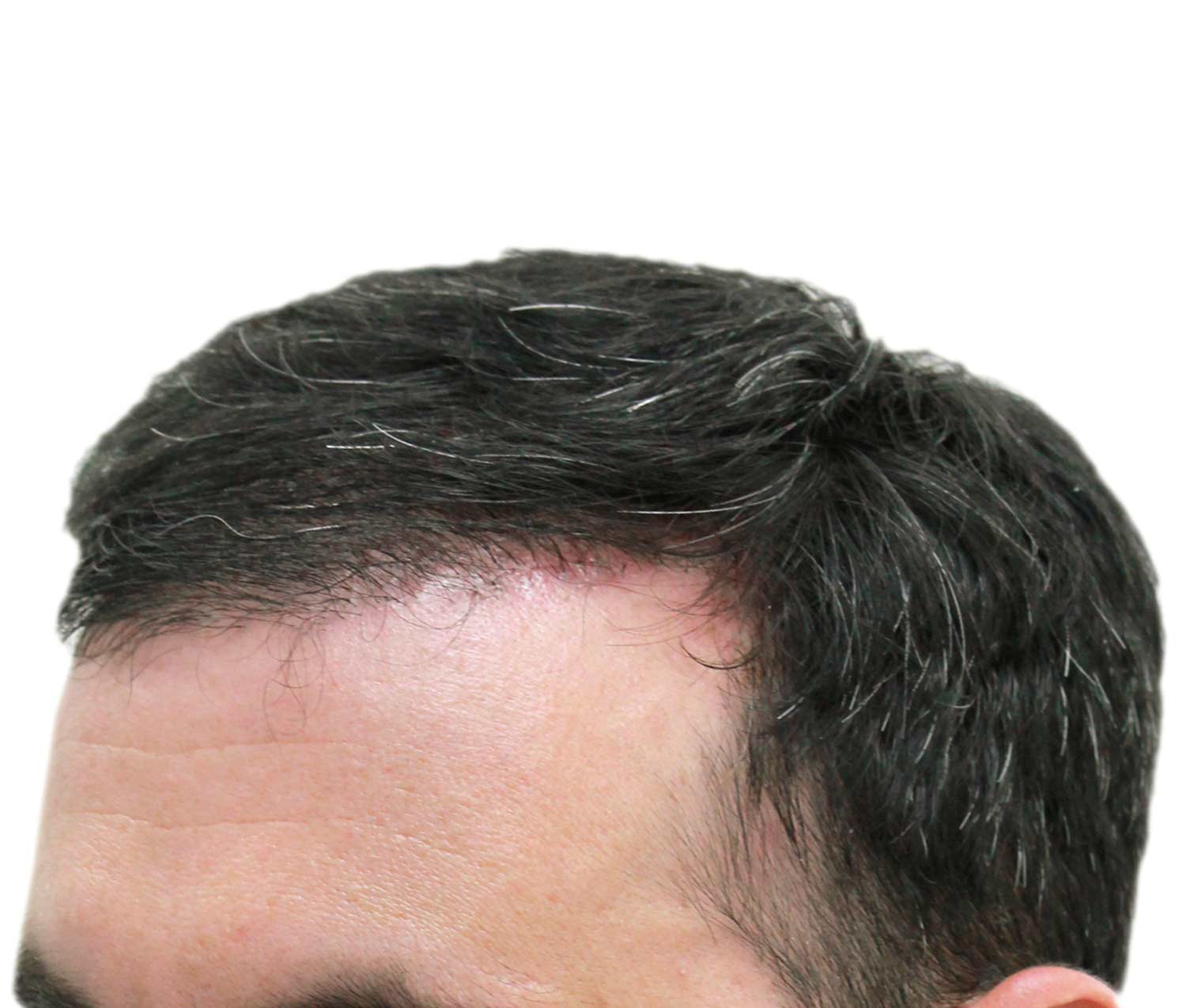 After hair restoration | Real patient, results may vary per individual