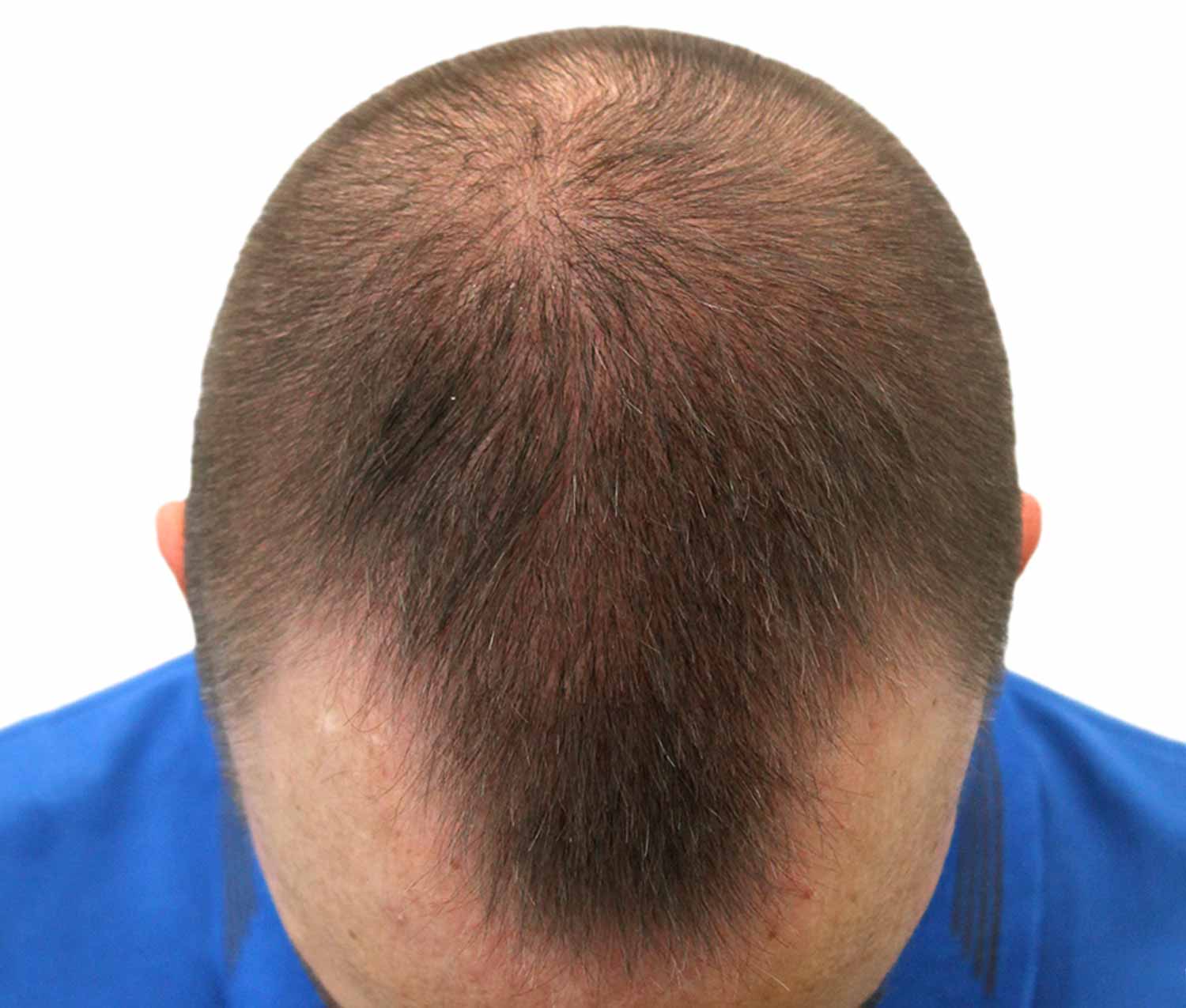Before hair restoration | Real patient, results may vary per individual