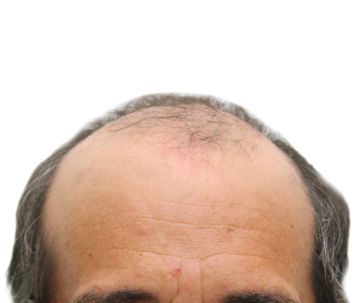 Before hair restoration | Real patient, results may vary per individual