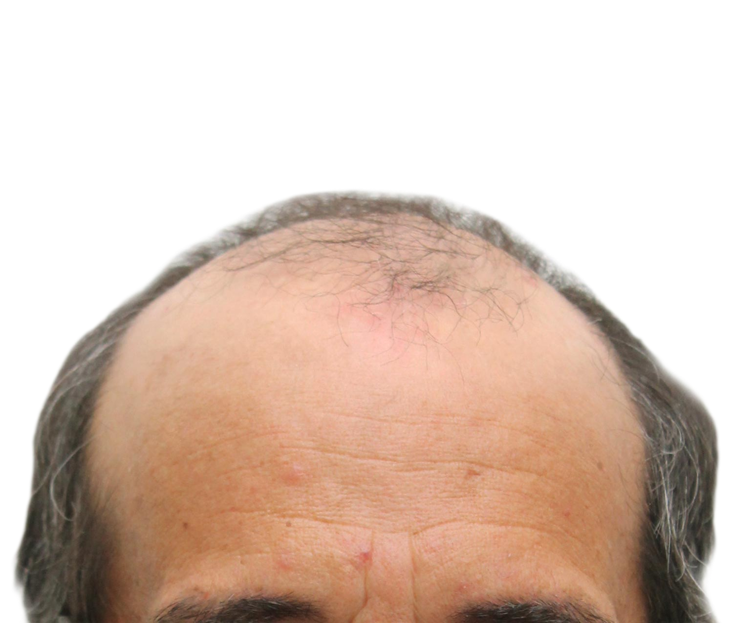 Before hair restoration | Real patient, results may vary per individual