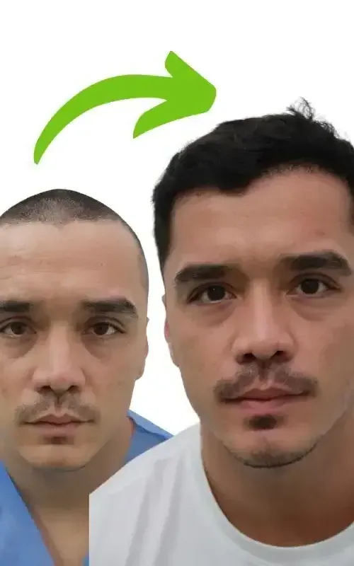 before and after hair trasplant