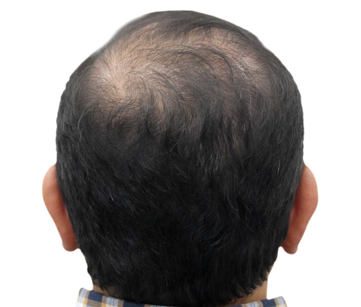 Before hair restoration | Real patient, results may vary per individual
