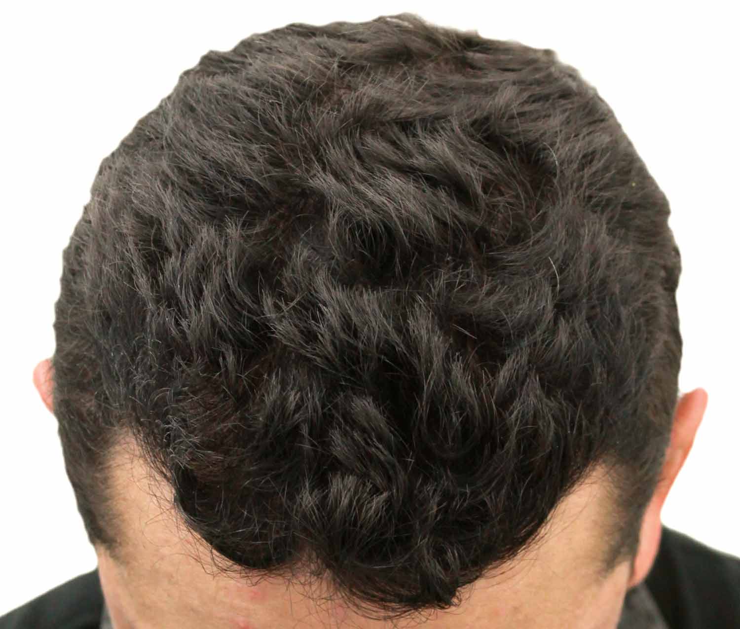 After hair restoration | Real patient, results may vary per individual
