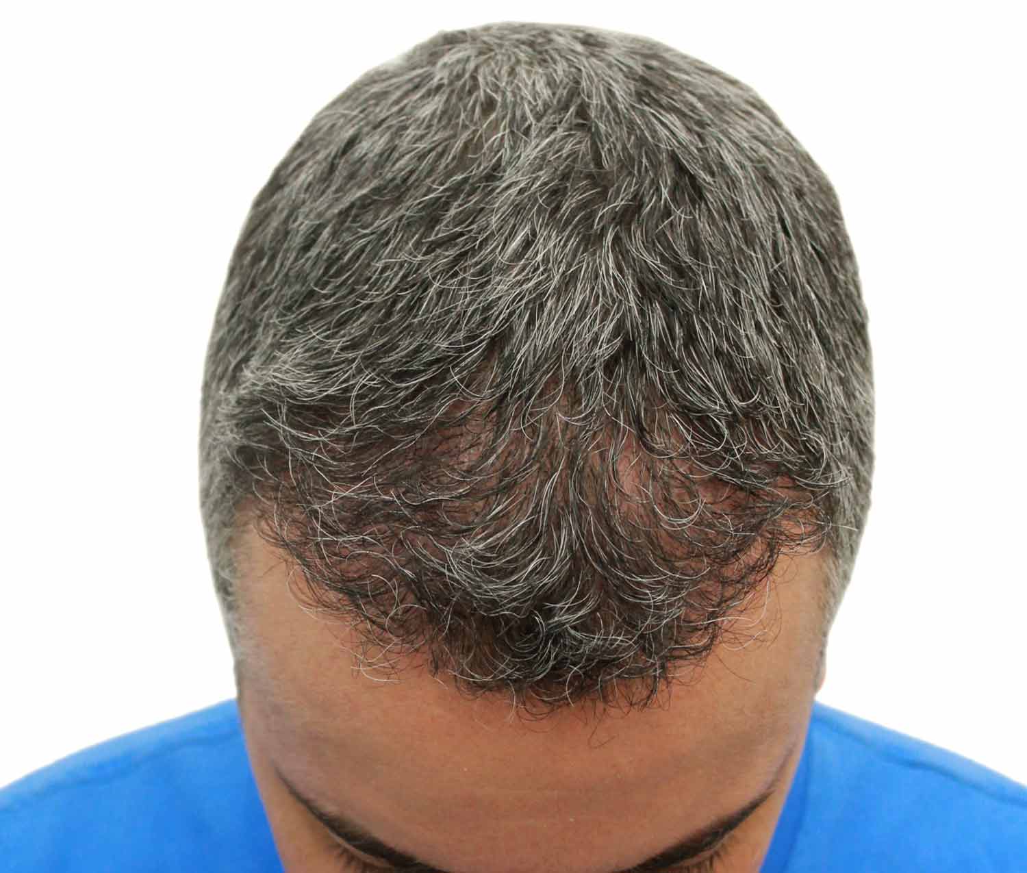 After hair restoration | Real patient, results may vary per individual