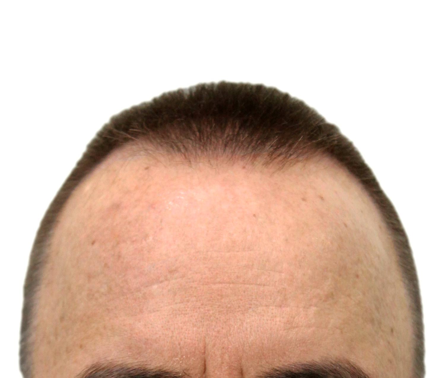 Before hair restoration | Real patient, results may vary per individual