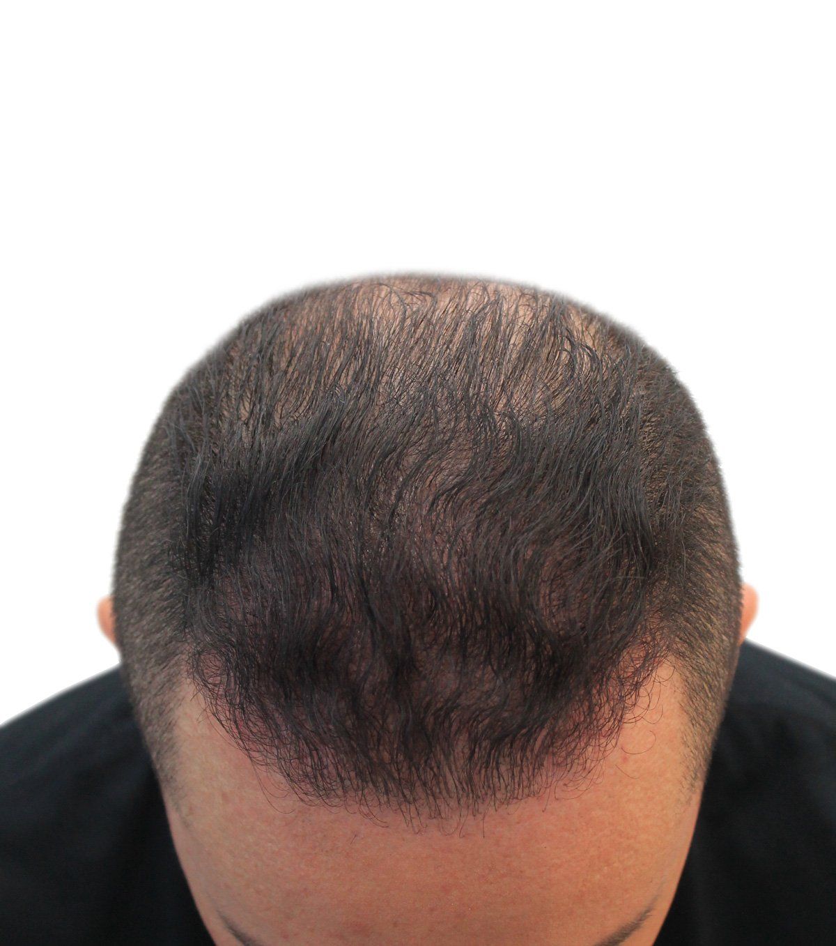 Man's head with thinning hair on top, short sides, and a dark shirt.