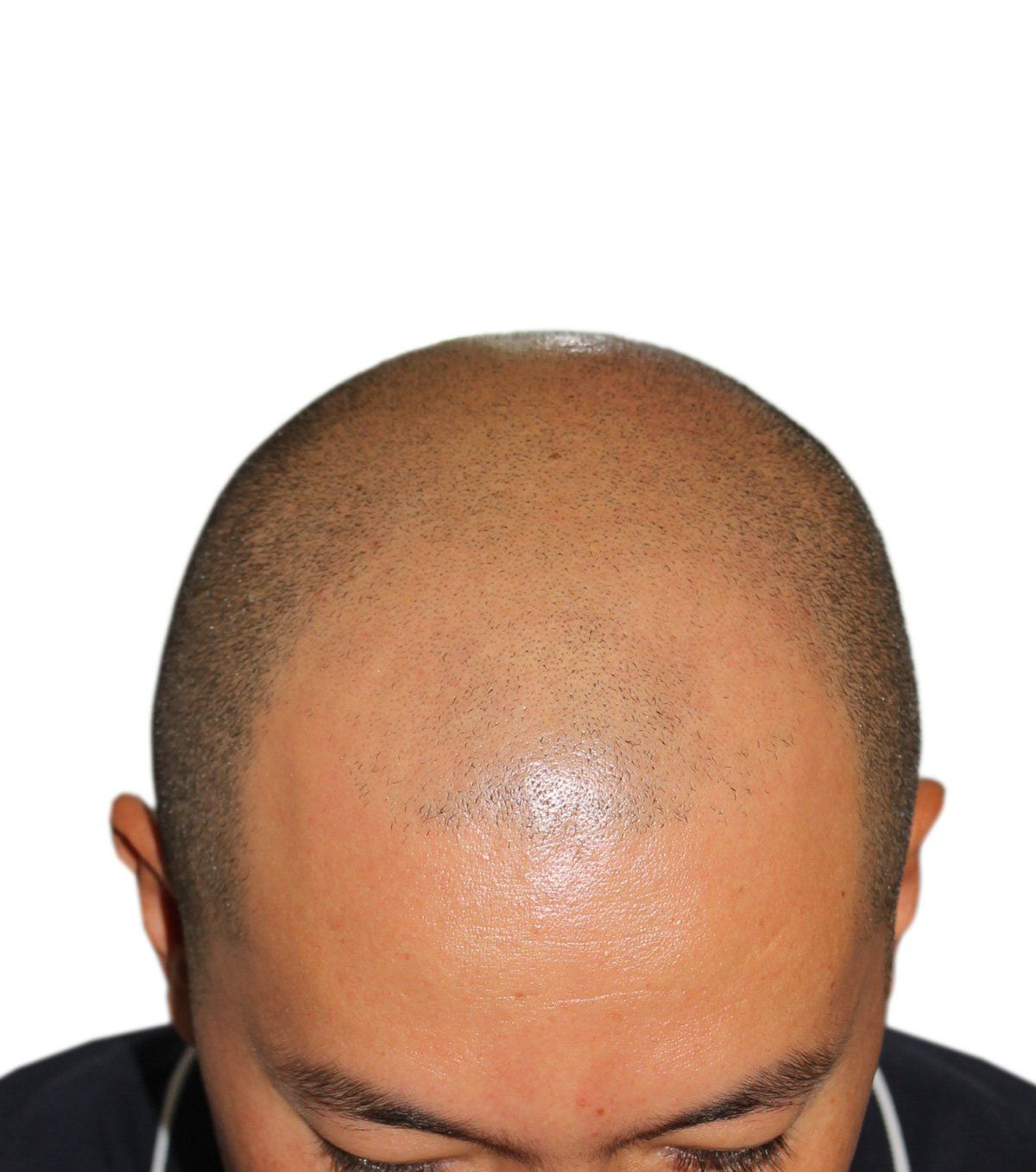 Close-up of a shaved head. The scalp is visible with a slight shine. The person is looking down.