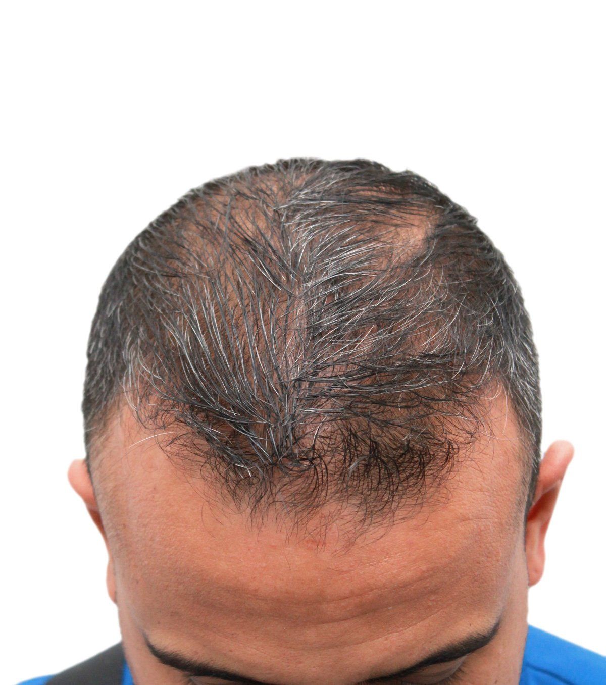 Man's balding scalp, with thinning dark and gray hair on white background.