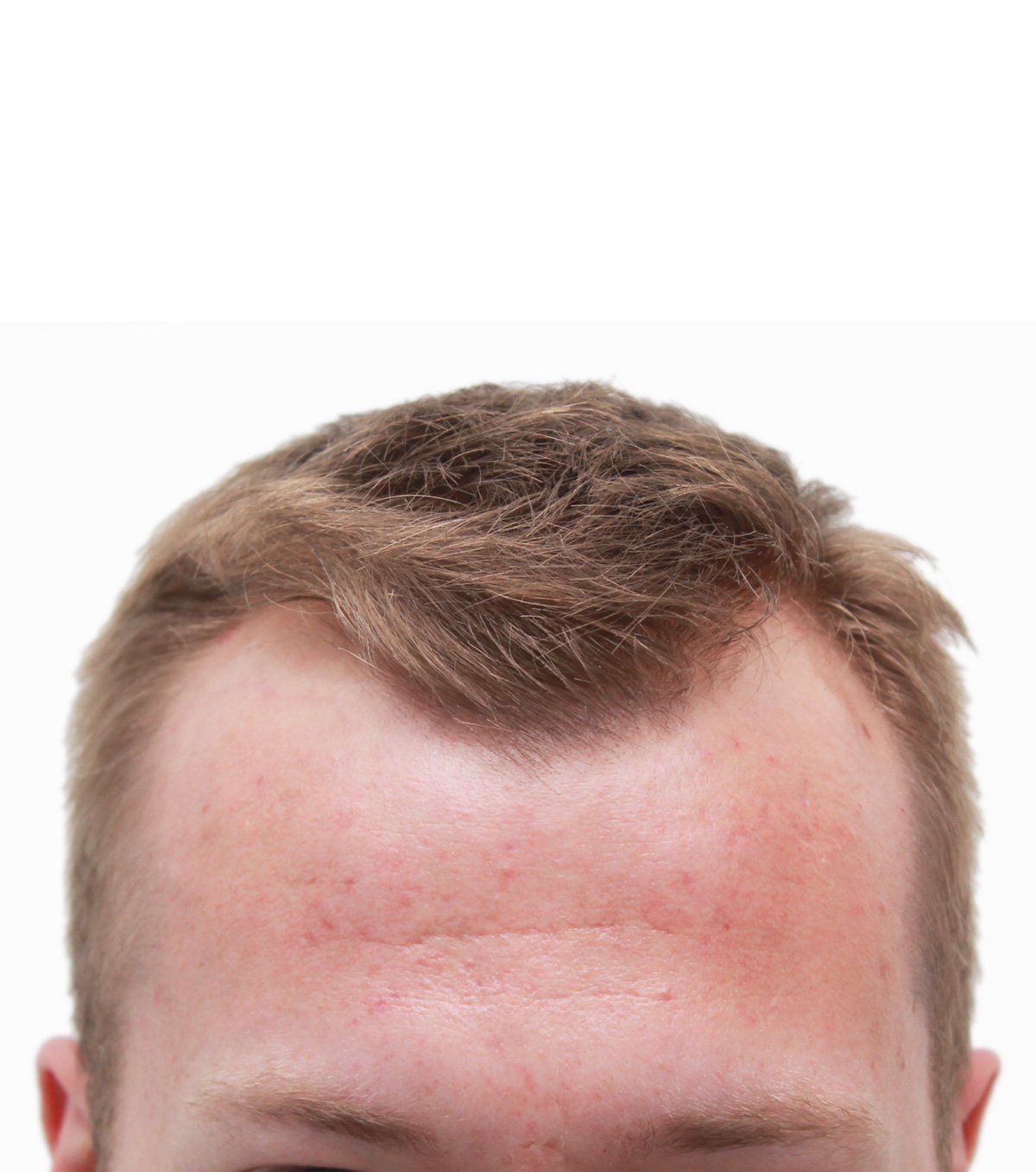 Close-up of a person's forehead and hair, light brown hair, and pale skin against a white background.
