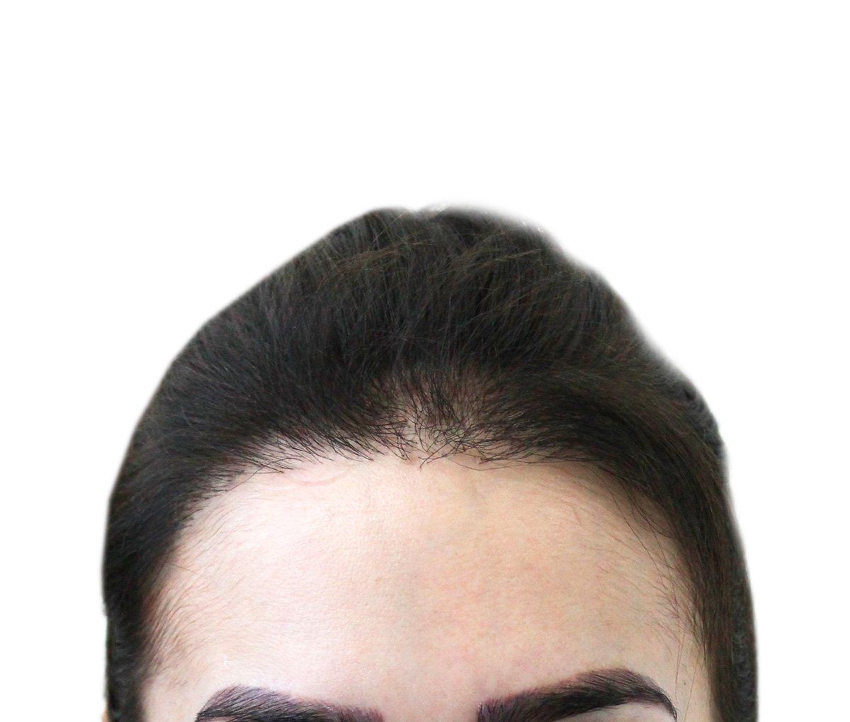 Forehead and hairline with dark hair against white background, possible hair thinning.